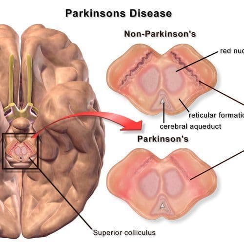 Scientists design peptide 'switch' that keeps Parkinson's protein in its healthy form