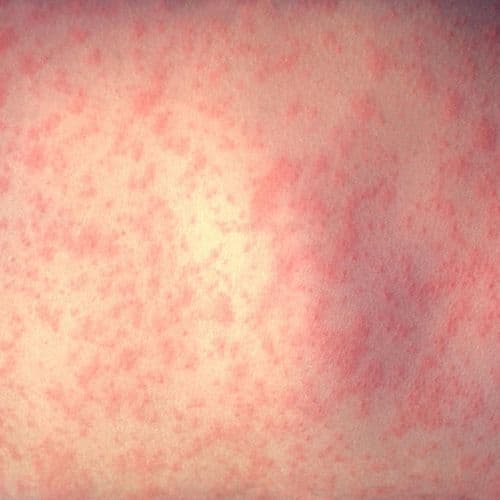 Measles alert issued for Northern Beaches